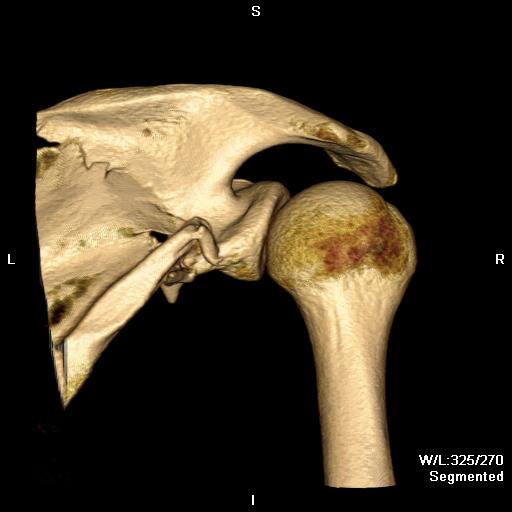 Scapular Blade Fracture CT